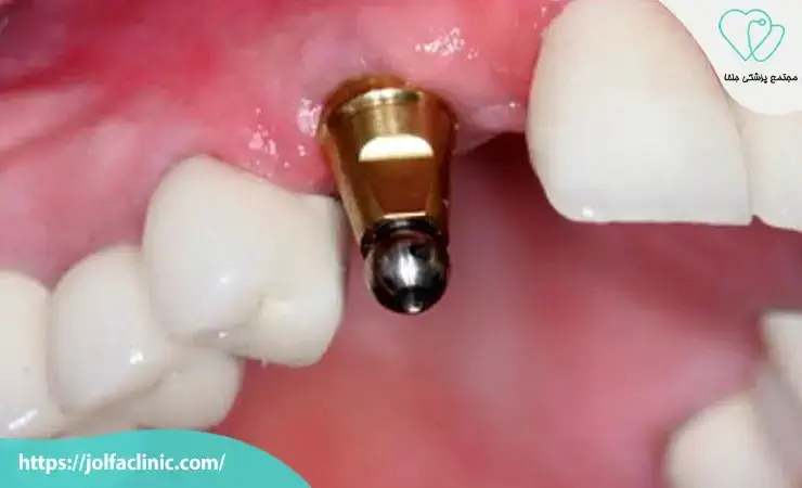 ایمپلنت فوری