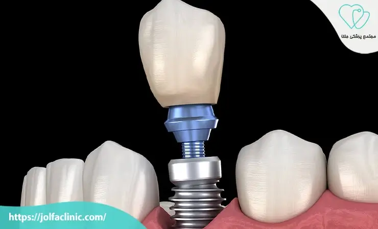 پروتز متکی بر ایمپلنت
