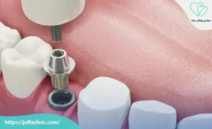 فیکسچر (Fixture) یا پایه تیتانیومی