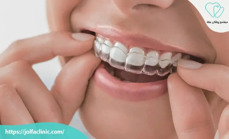 ارتودنسی نامرئی یا اینویزیلاین