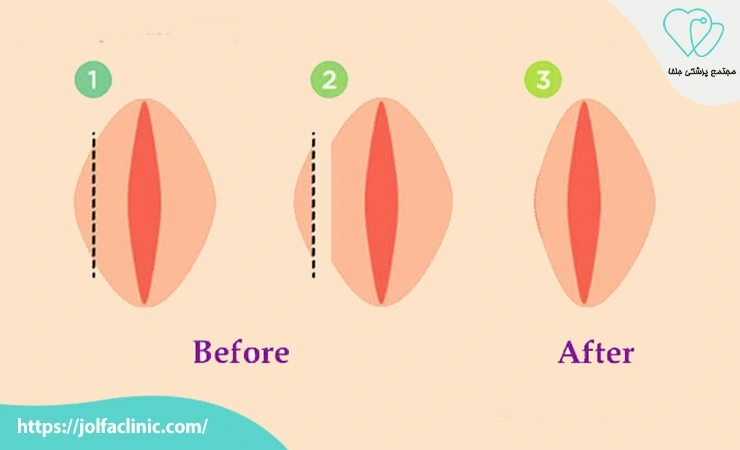 روش برش مستقیم (Trim Technique)