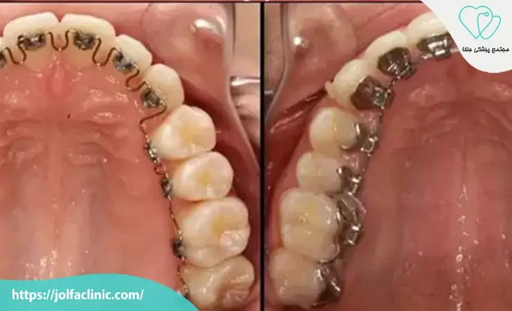 ارتودنسی لینگوال