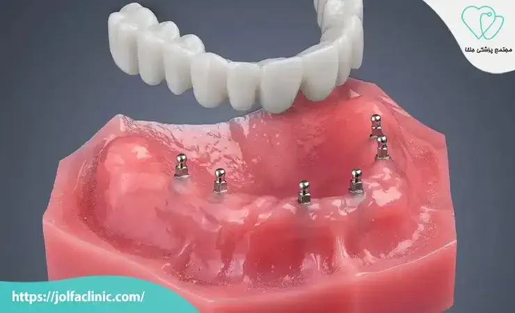 ایمپلنت مینی