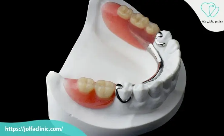 پروتز دندان پارسیل