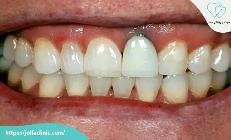 عوارض احتمالی ایمپلنت دندان