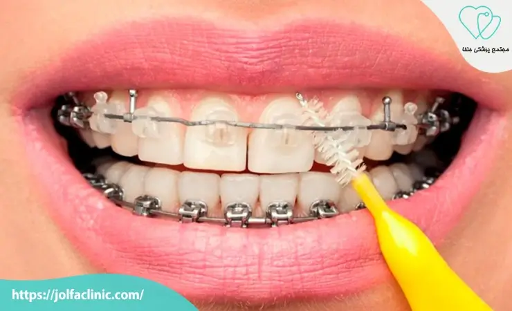 مراقبت های بعد از ارتودنسی