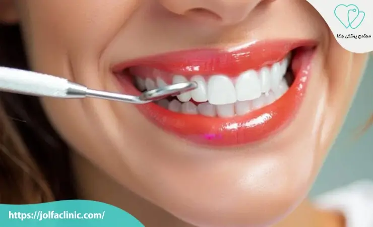 مراقبت های بعد از لمینت دندان