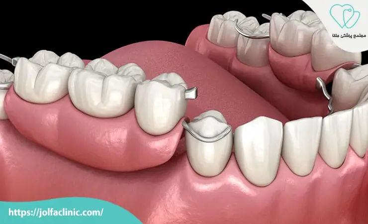 پروتز دندان متحرک
