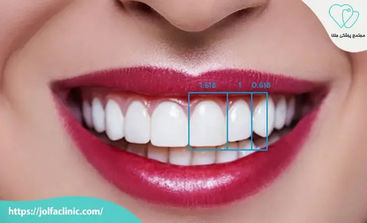 قیمت لمینت دندان طرح لبخند