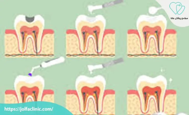 مراحل انجام کامپوزیت دندان
