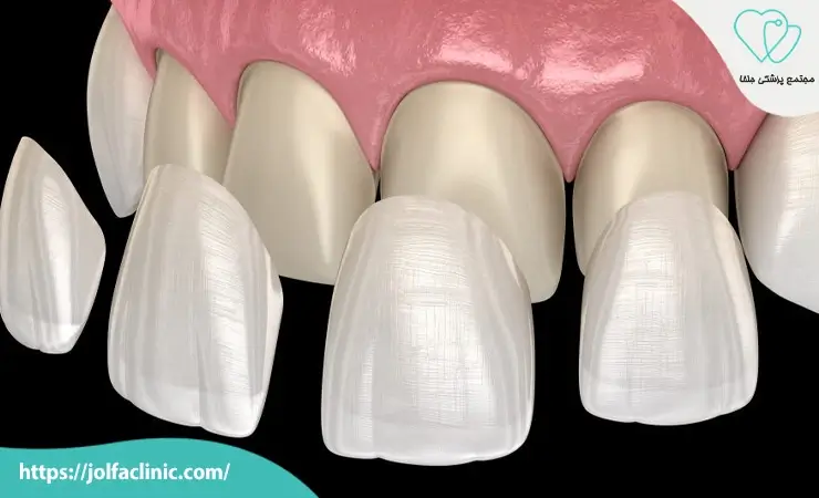 مراحل انجام لمینت دندان