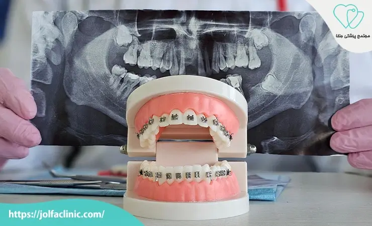 مراحل انجام ارتودنسی دندان