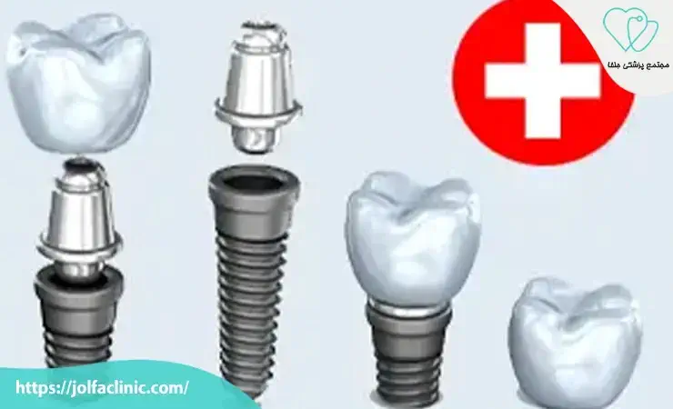 ایمپلنت های سوئیسی