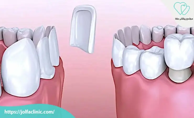 فرق لمینت و کامپوزیت دندان