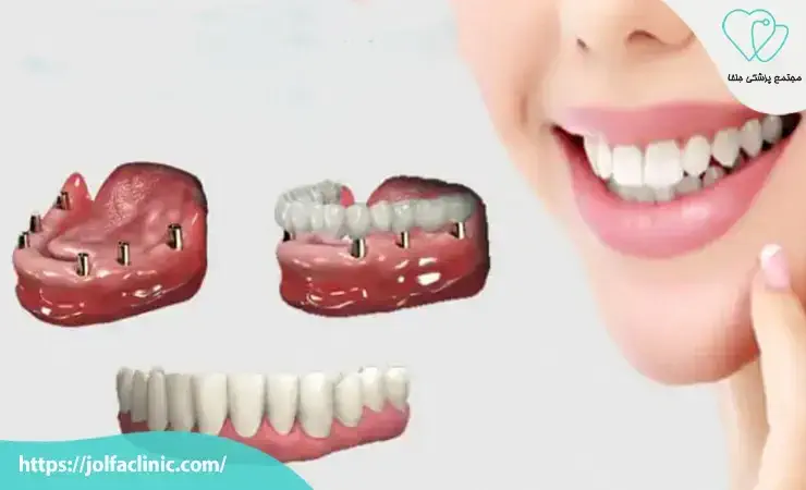 انواع ایمپلنت دندان