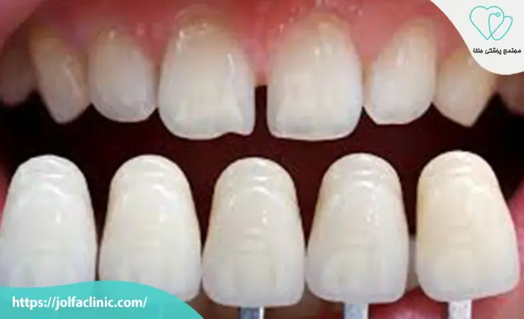 انواع لمینت دندان