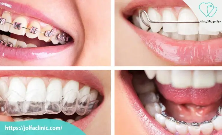 انواع ارتودنسی دندان