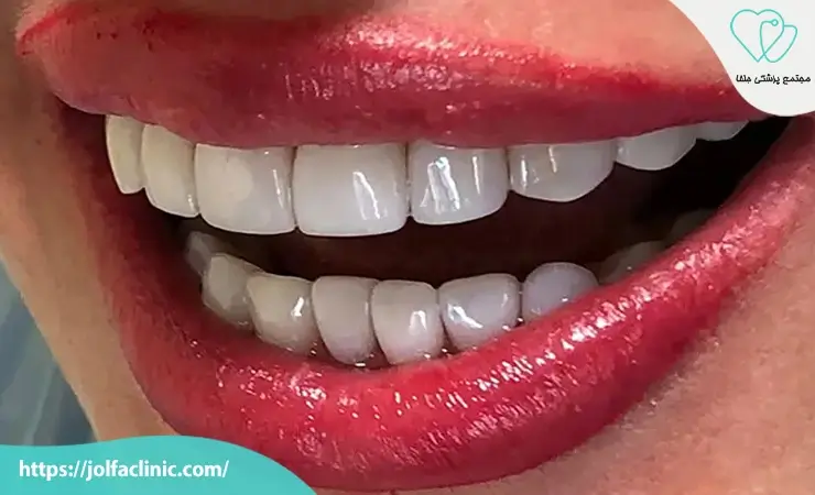 طول عمر کامپوزیت چقدر است؟