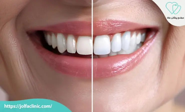 طول عمر لمینت دندان چقدر است؟