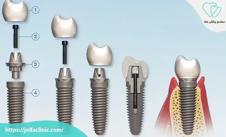 ایمپلنت از چه بخش هایی تشکیل شده است؟