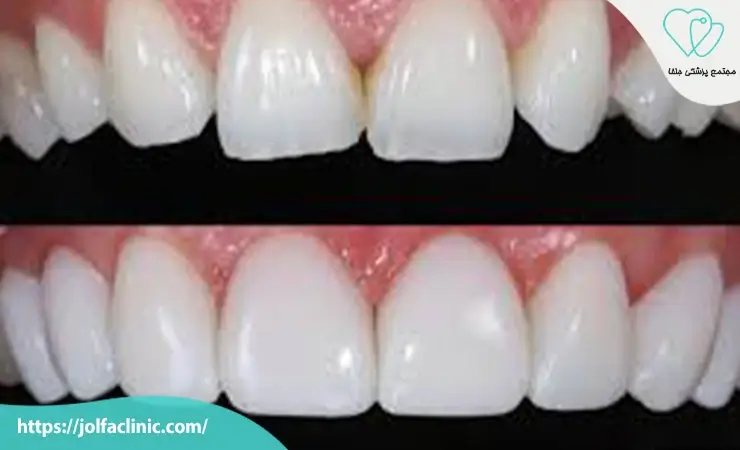 چه کسانی بهترین کاندید کامپوزیت دندان هستند