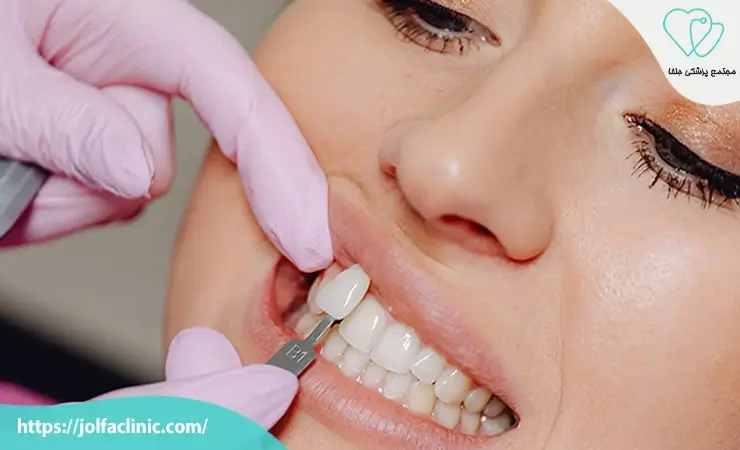 لمینت دندان برای چه افرادی مناسب است