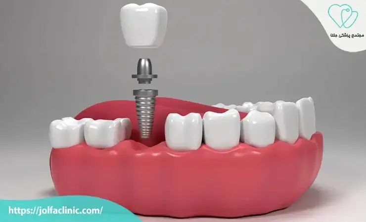 چرا ایمپلنت بهترین گزینه جایگزینی دندان است؟