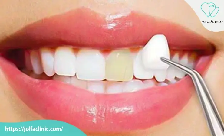 مزایای لمینت دندان نسبت به روش های دیگر