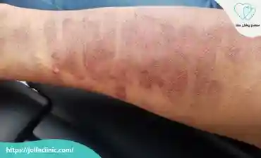 سوختگی بعد از لیزر موهای زائد