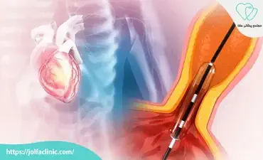 علت بی‌ حالی بعد از آنژیوگرافی چیست؟