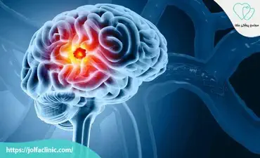 تومور مغزی چیست؟