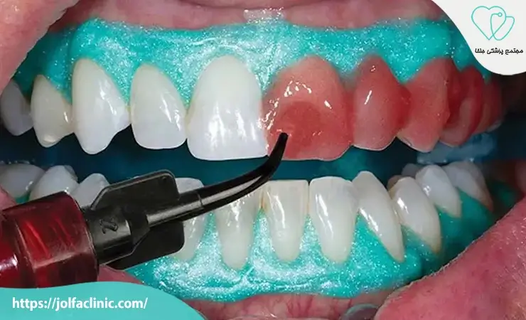 مزایا و معایب انواع بلیچینگ دندان