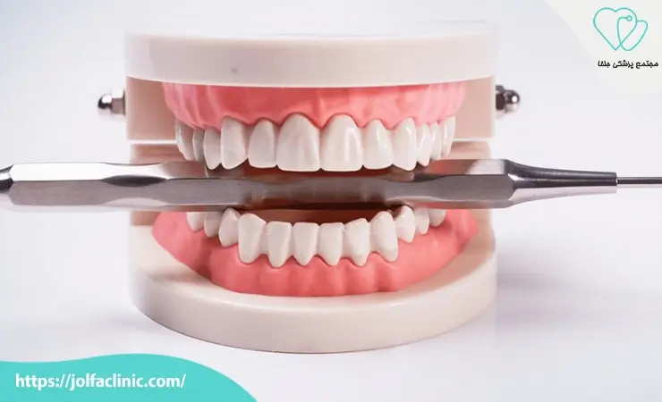 مزایای عصب کشی دندان