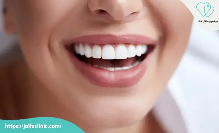مزایای بلیچینگ دندان