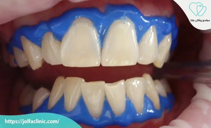 بلیچینگ ترکیبی