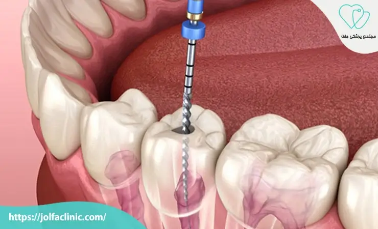 هزینه عصب کشی دندان