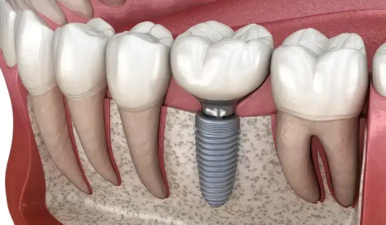 ایمپلنت دندان