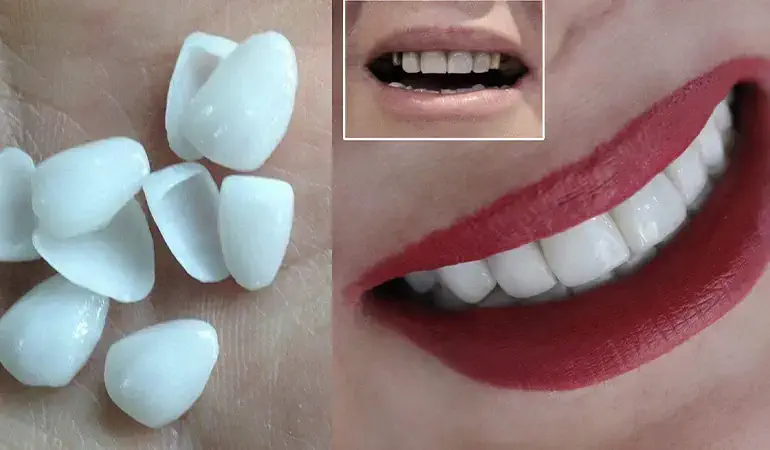 لمینت دندان