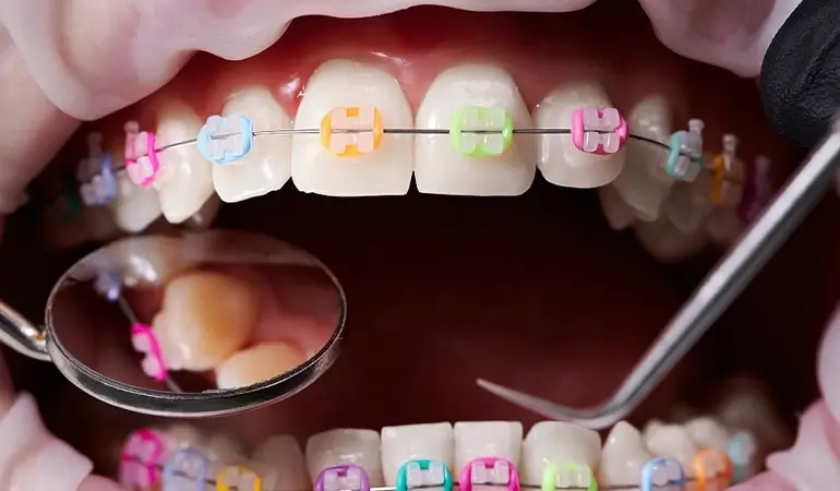 ارتودنسی دندان
