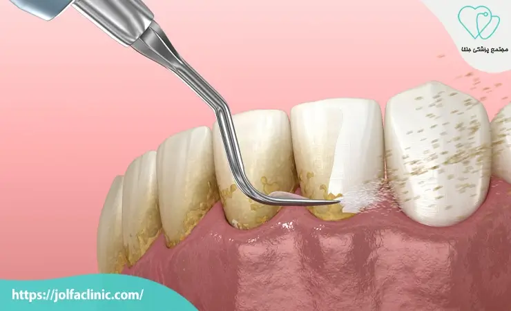 جرم گیری دندان