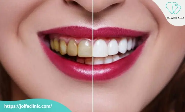 ماندگاری بلیچینگ دندان چقدر است؟