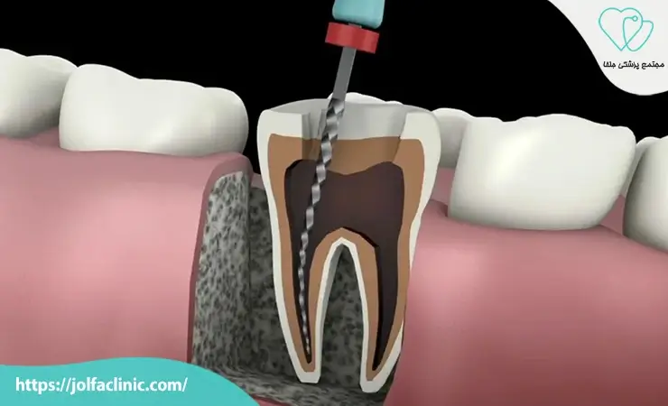 عصب کشی دندان چند جلسه طول می کشد؟