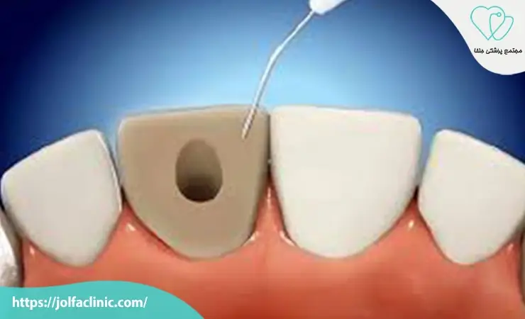 بلیچینگ داخلی دندان