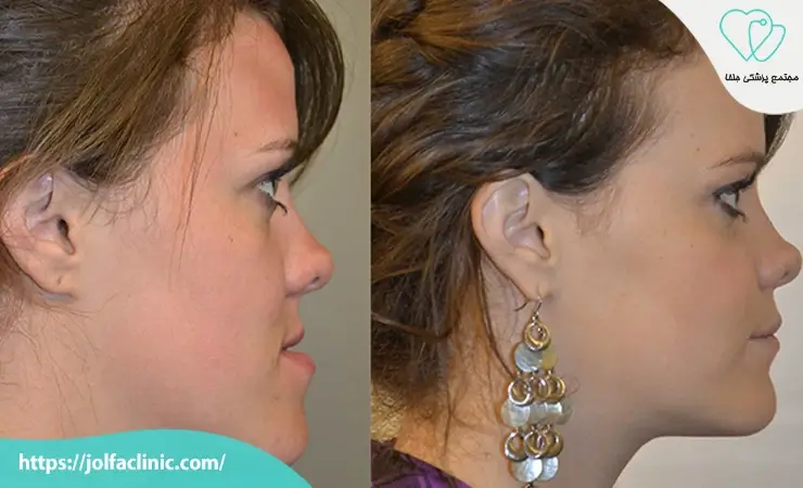 جراحی دندان های نهفته