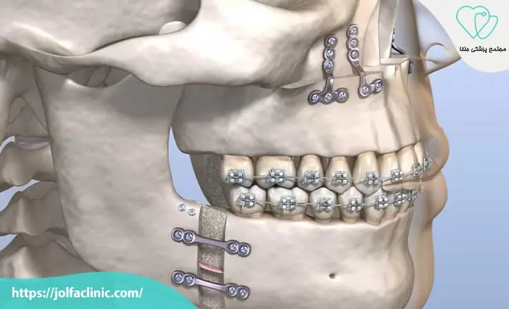 درمان شکستگی های فک و صورت