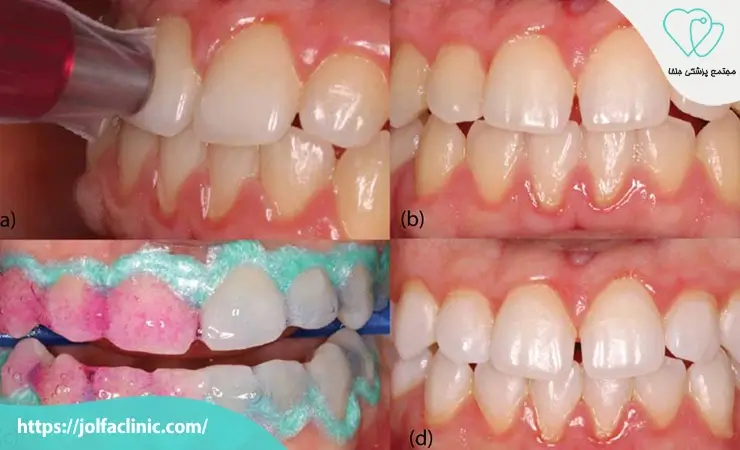 مراحل انجام بلیچینگ دندان