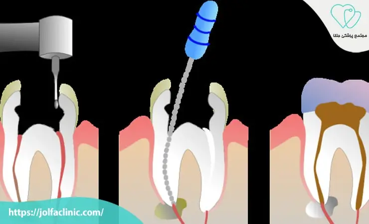 مراحل عصب کشی دندان