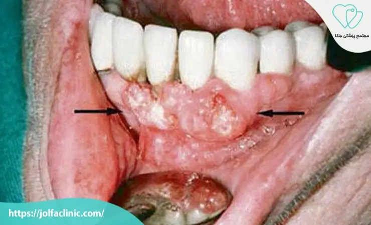 ایمپلنت دندان و جراحی های بازسازی استخوان