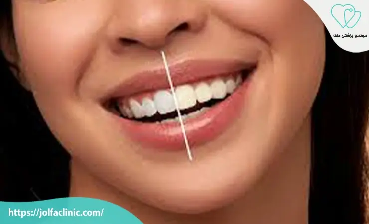 بلیچینگ دندان