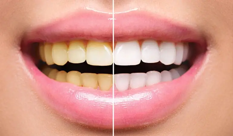 بلیچینگ دندان